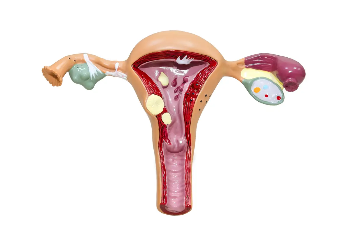 Abordagem das infecções genitais femininas e tratamento empírico da dip 2 Plastic model of woman reproductive system isolated on white. Anatomical model of uterus with ovaries
