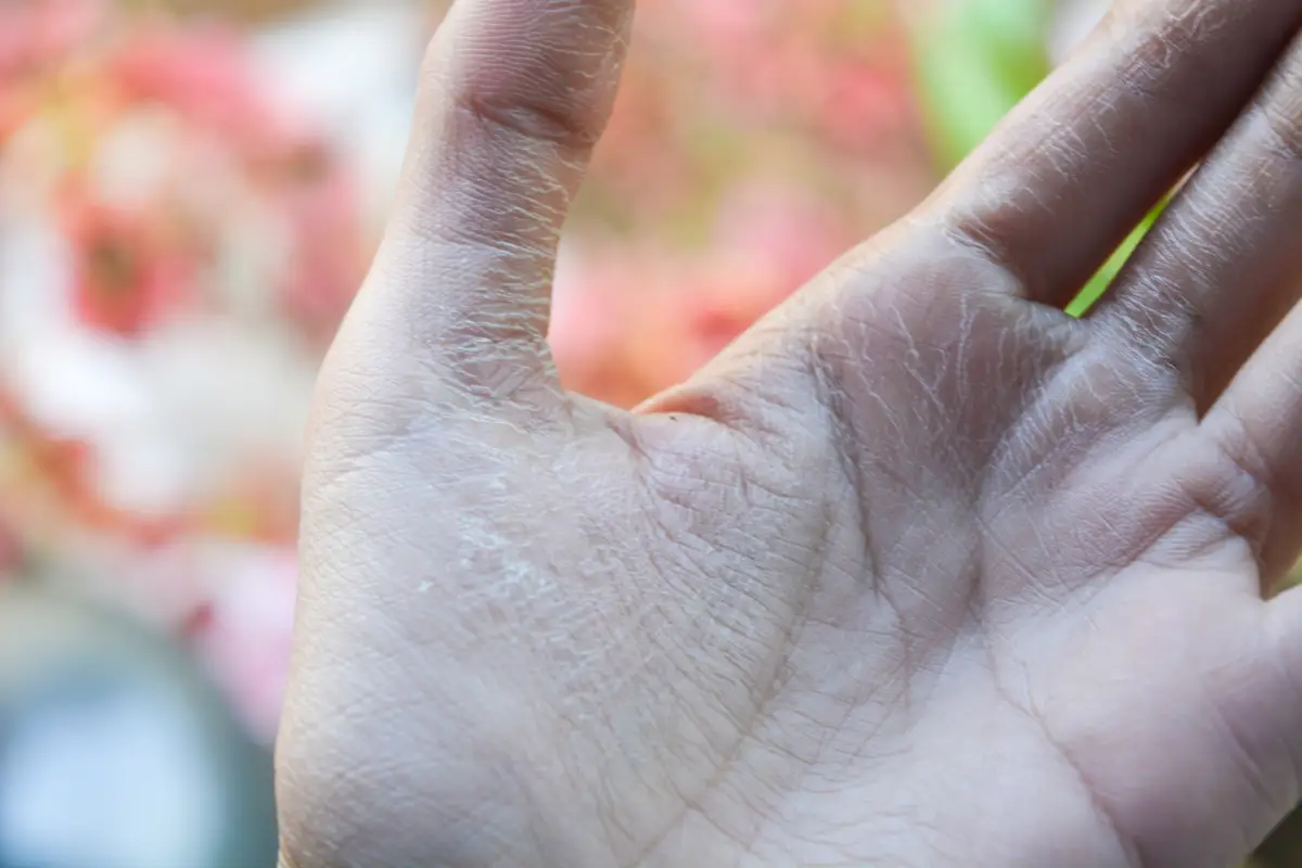 Infecções cutâneas por micobactérias não tuberculosas em imunocompetentes 2 Close up photo of sore fingers