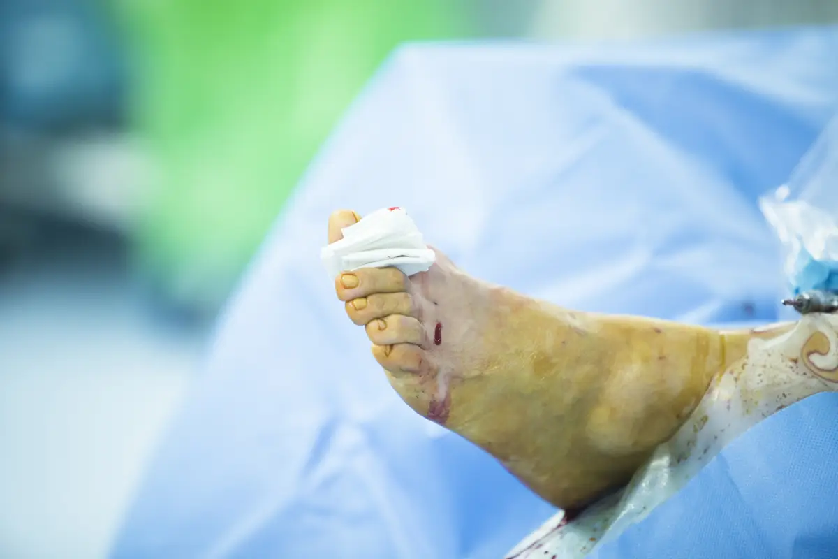 Resposta imune e autoanticorpos na endocardite infecciosa 4 Low section of injured patient lying on hospital bed