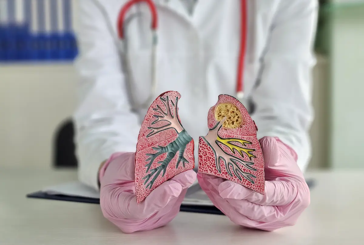 Tratamento da pneumonia por anaeróbios na aspiração e metronidazol 1 Lung cancer asthma chronic obstructive pulmonary disease or COPD bronchitis emphysema concept