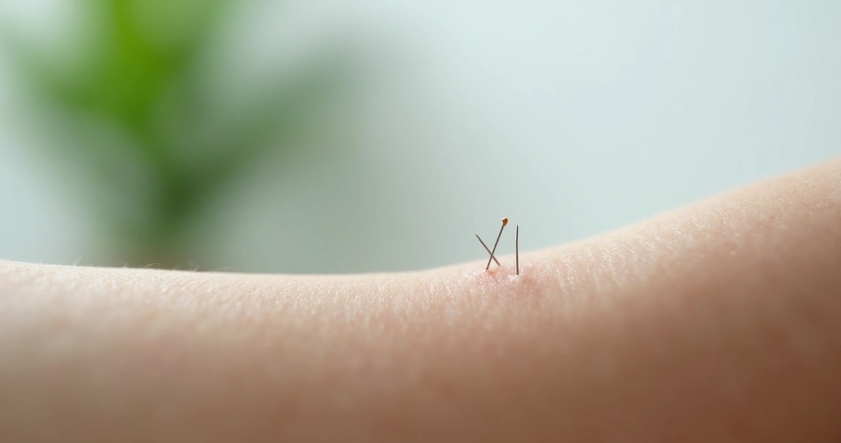 Detalhe de uma agulha de acupuntura inserida na pele 