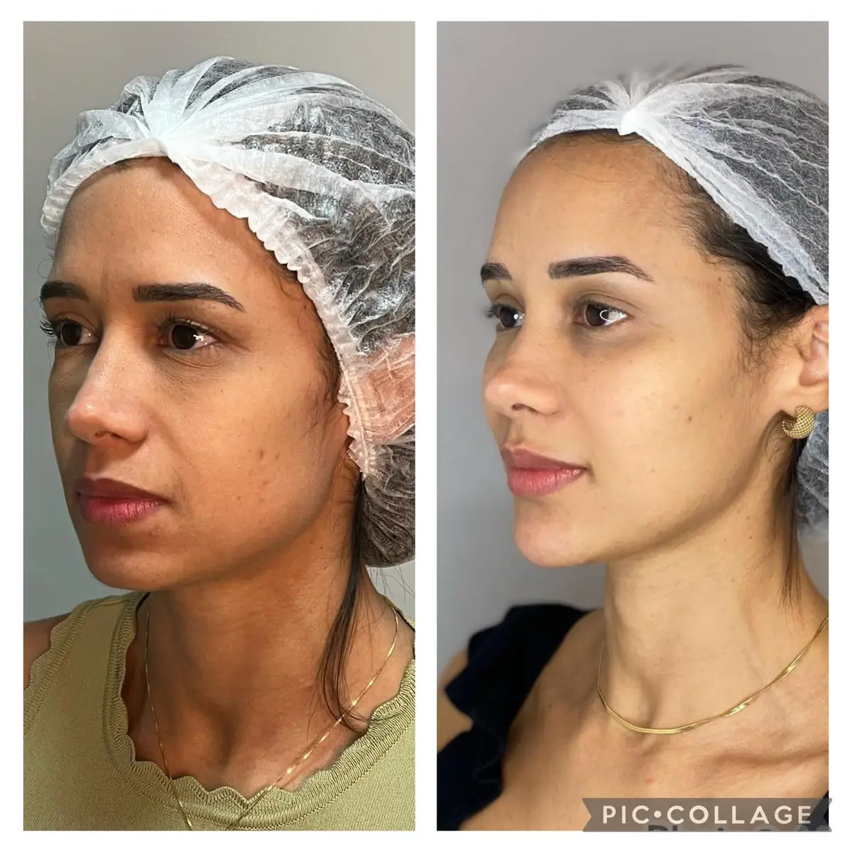 Antes e depois da harmonização facial de uma mulher com touca descartável branca
