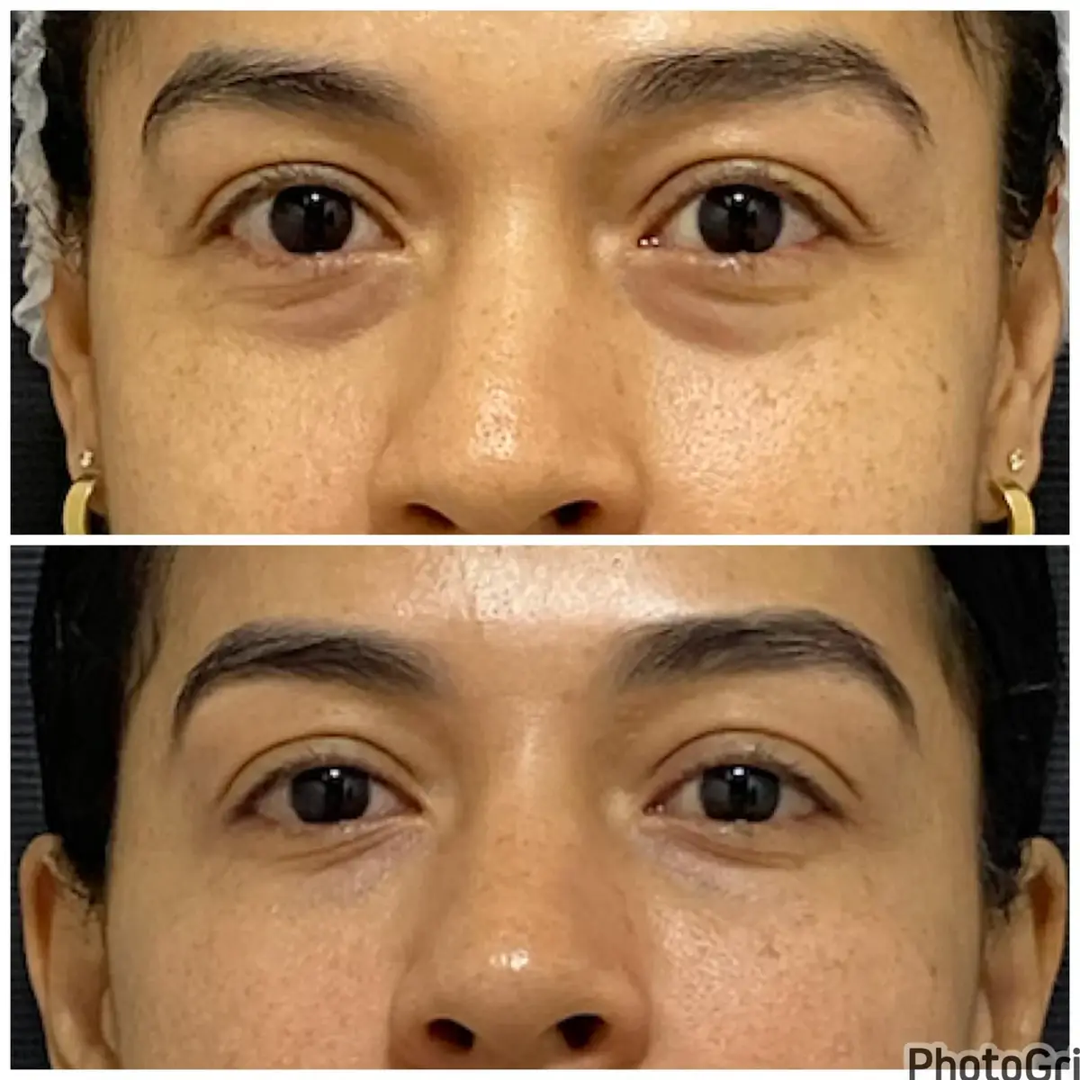 Antes e depois de paciente com redução das olheiras e melhora da textura da pele ao redor dos olhos