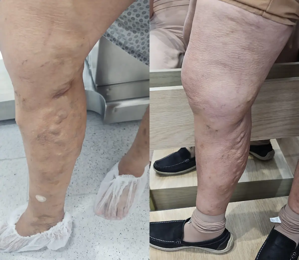 Comparação de pernas com varizes antes e depois do tratamento