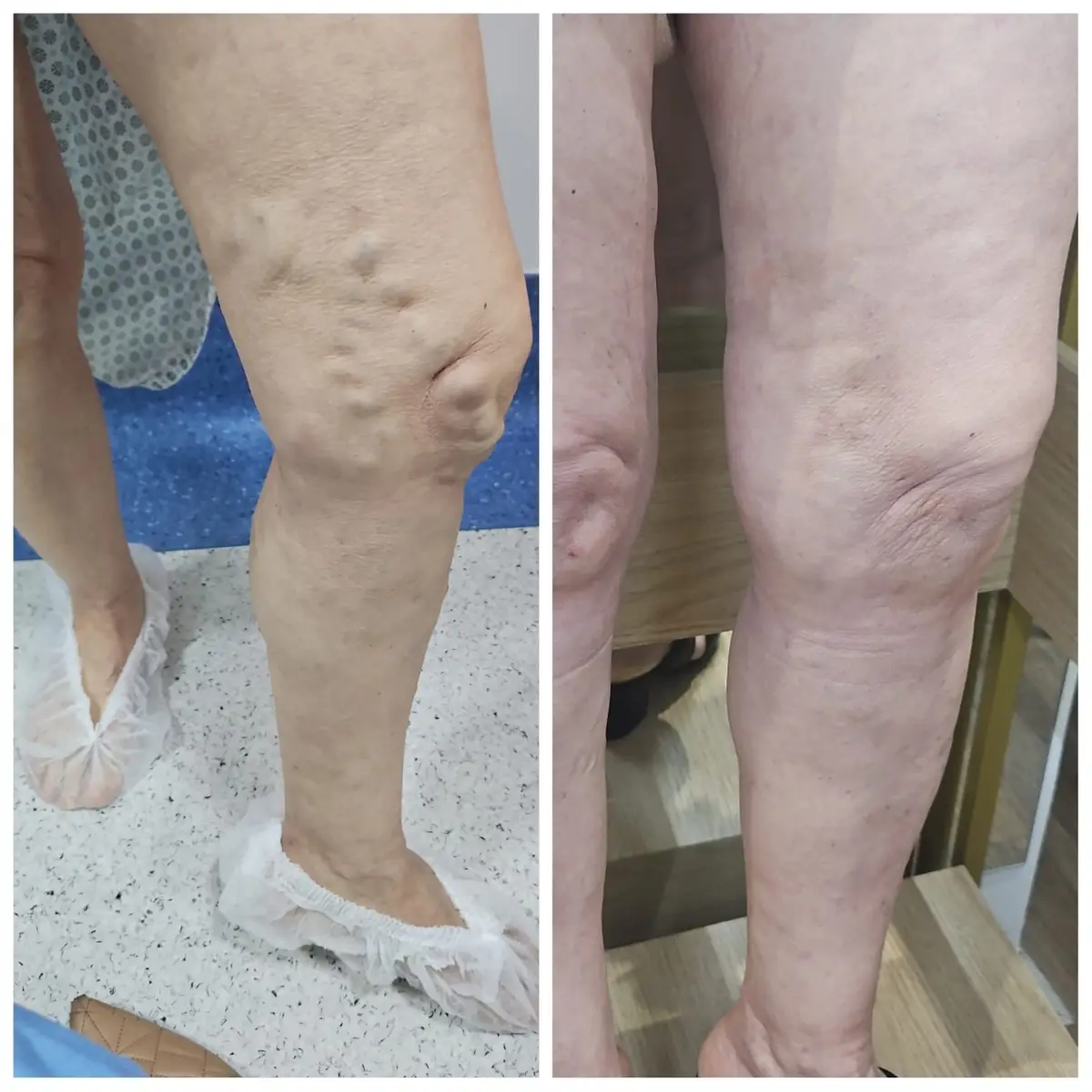 Fotos comparativas de pernas com varizes antes e depois do tratamento