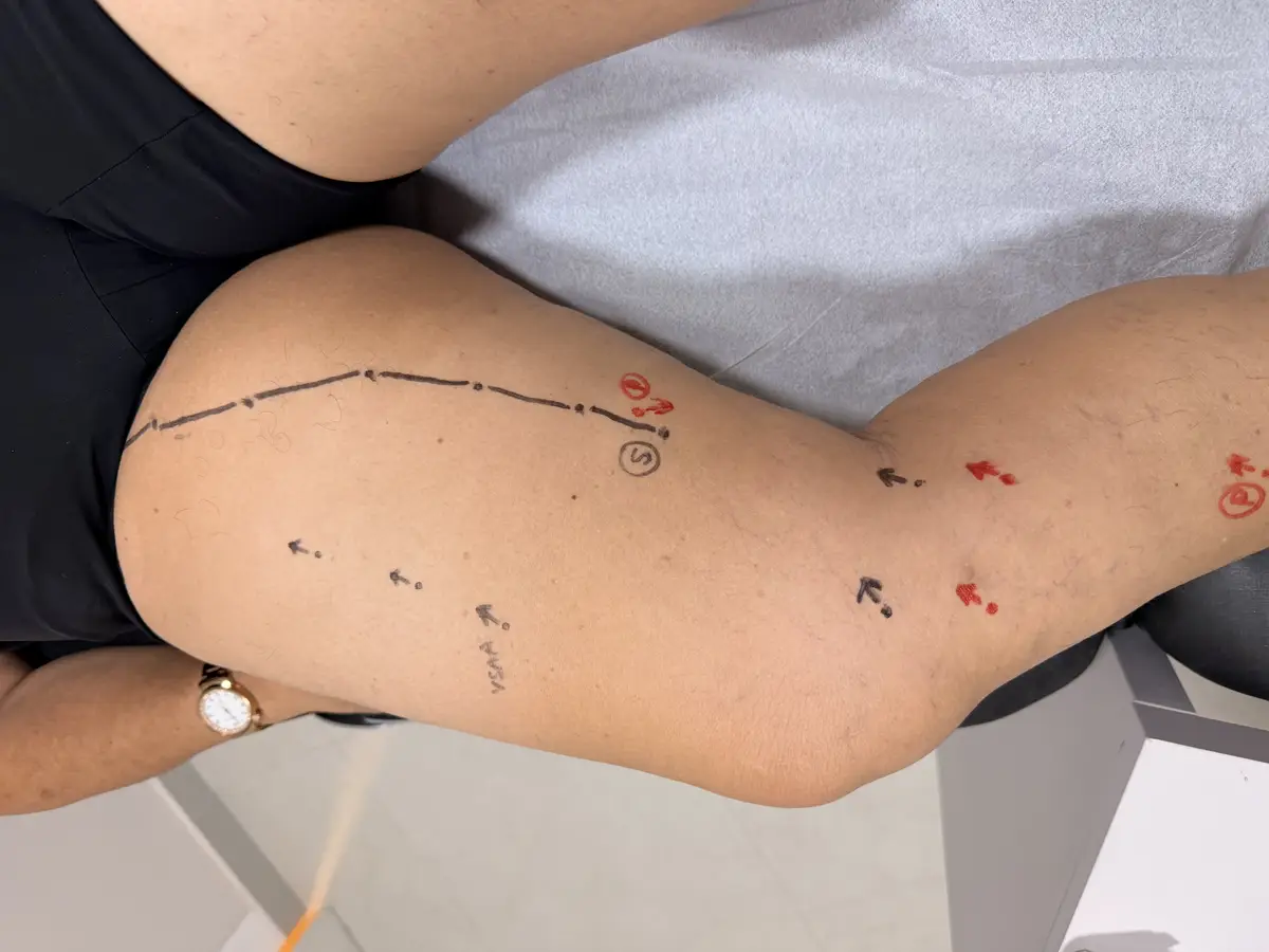 Perna com marcações médicas para tratamento de varizes usando técnica ATTA