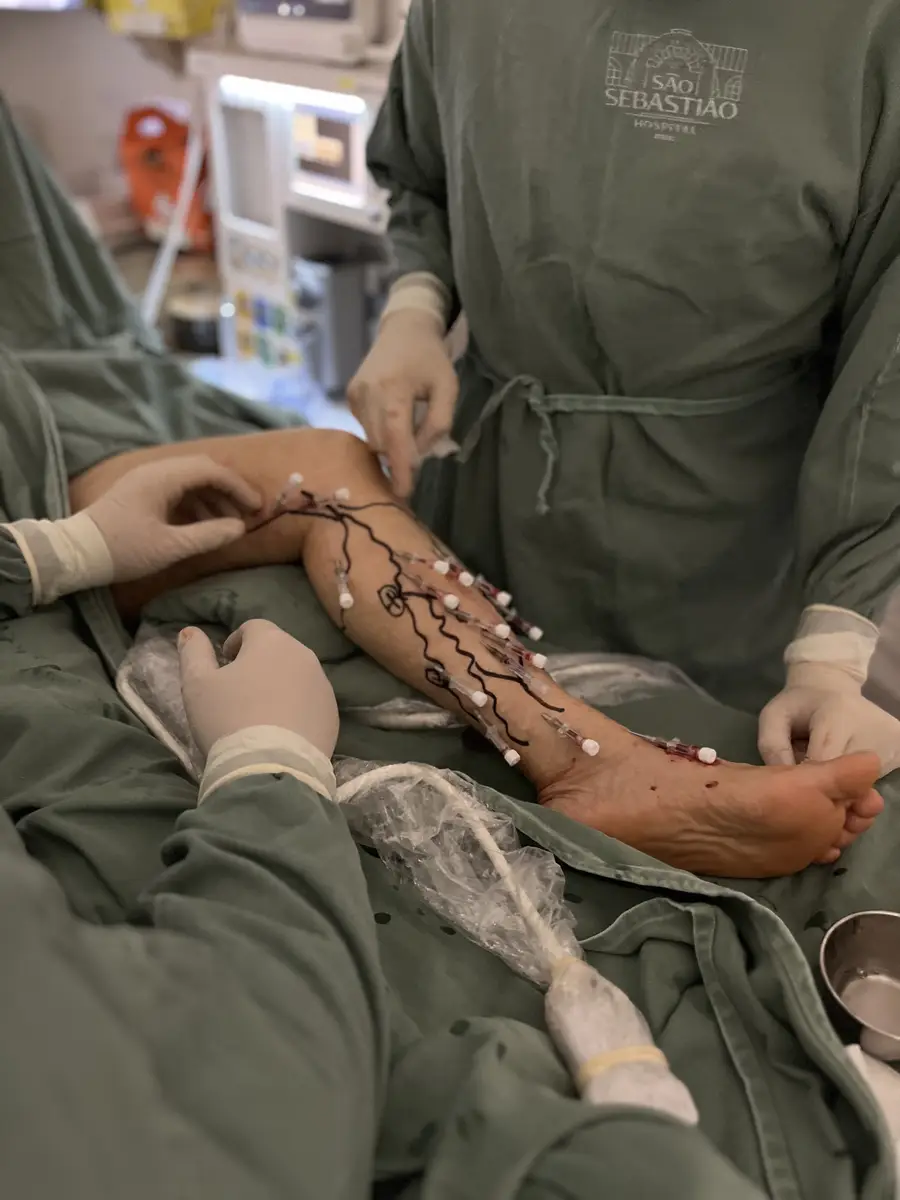 Perna com marcações vasculares sendo preparado por profissionais com luvas cirúrgicas