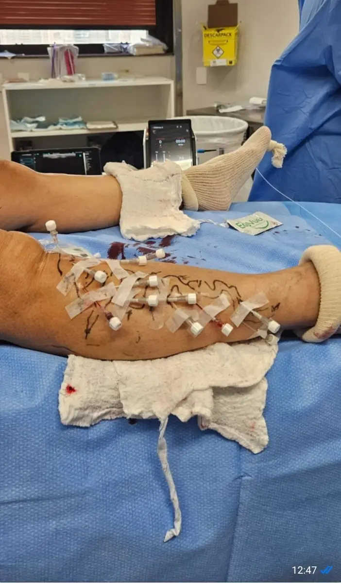 Perna de paciente com várias micropartículas adesivas transparentes e marcações de caneta preta, durante procedimento médico vascular