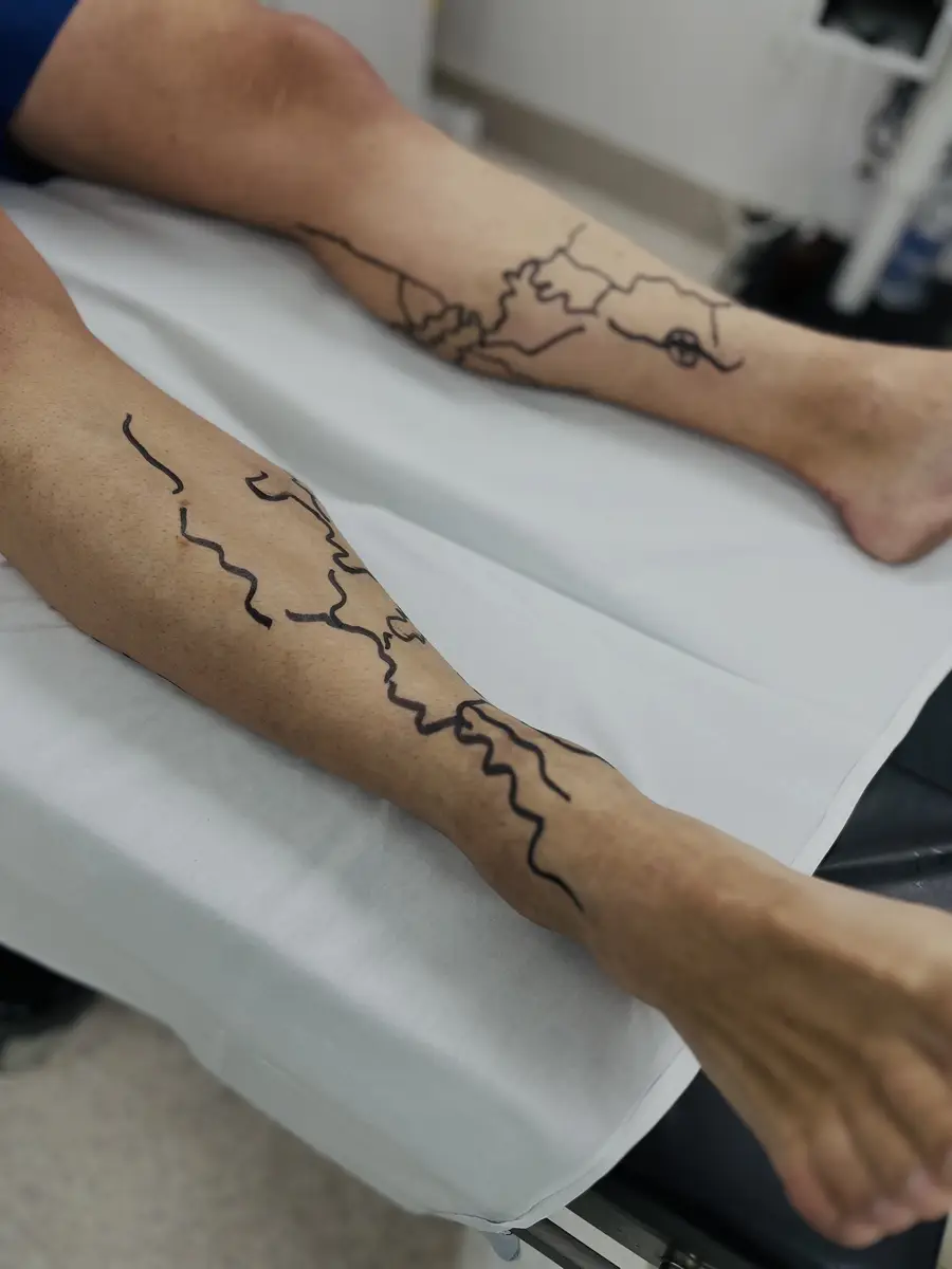 Perna de paciente com varizes marcadas para tratamento médico