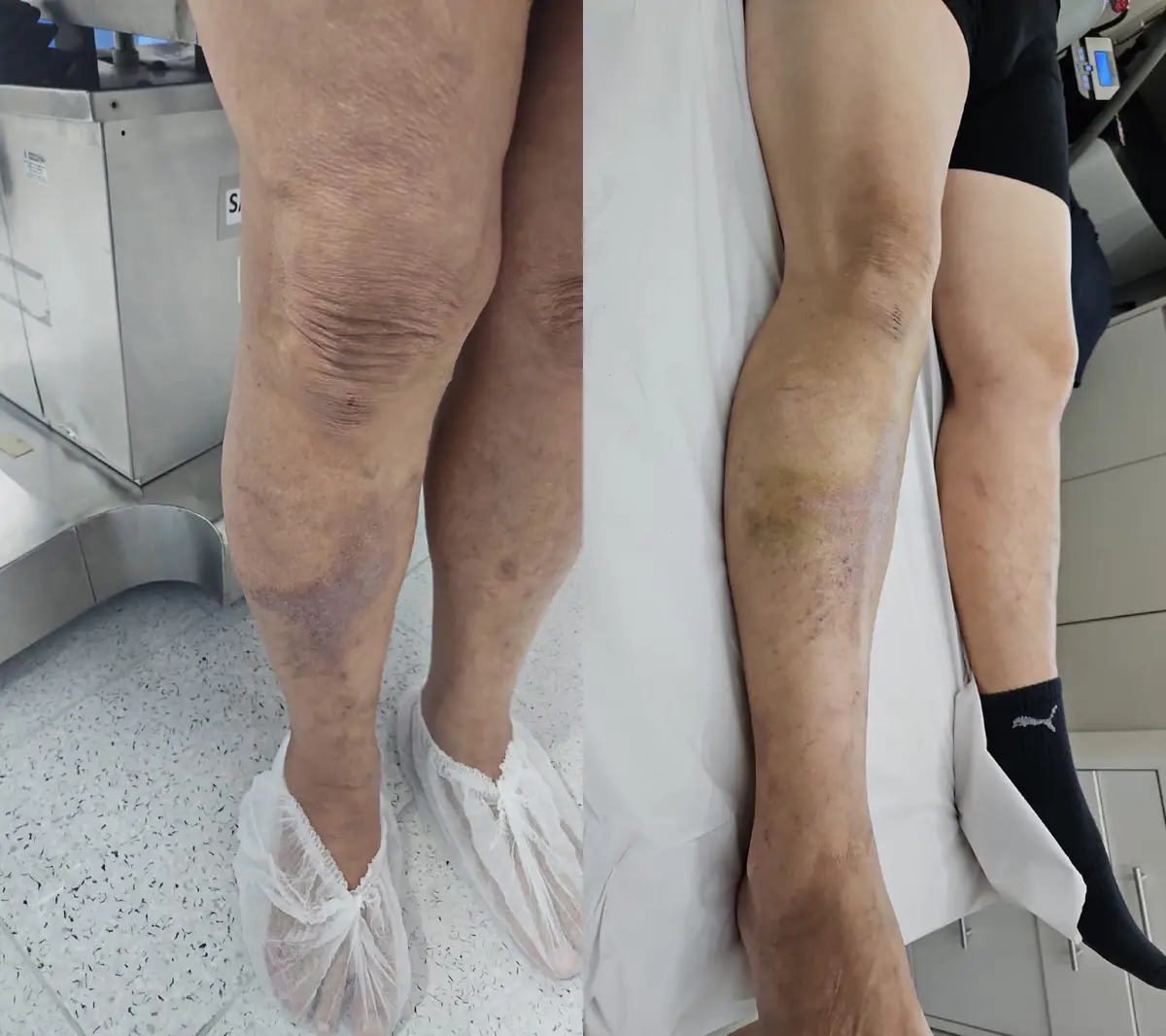 Pernas de paciente com hematomas e manchas roxas visíveis nas regiões abaixo dos joelhos, em ambiente clínico hospitalar.