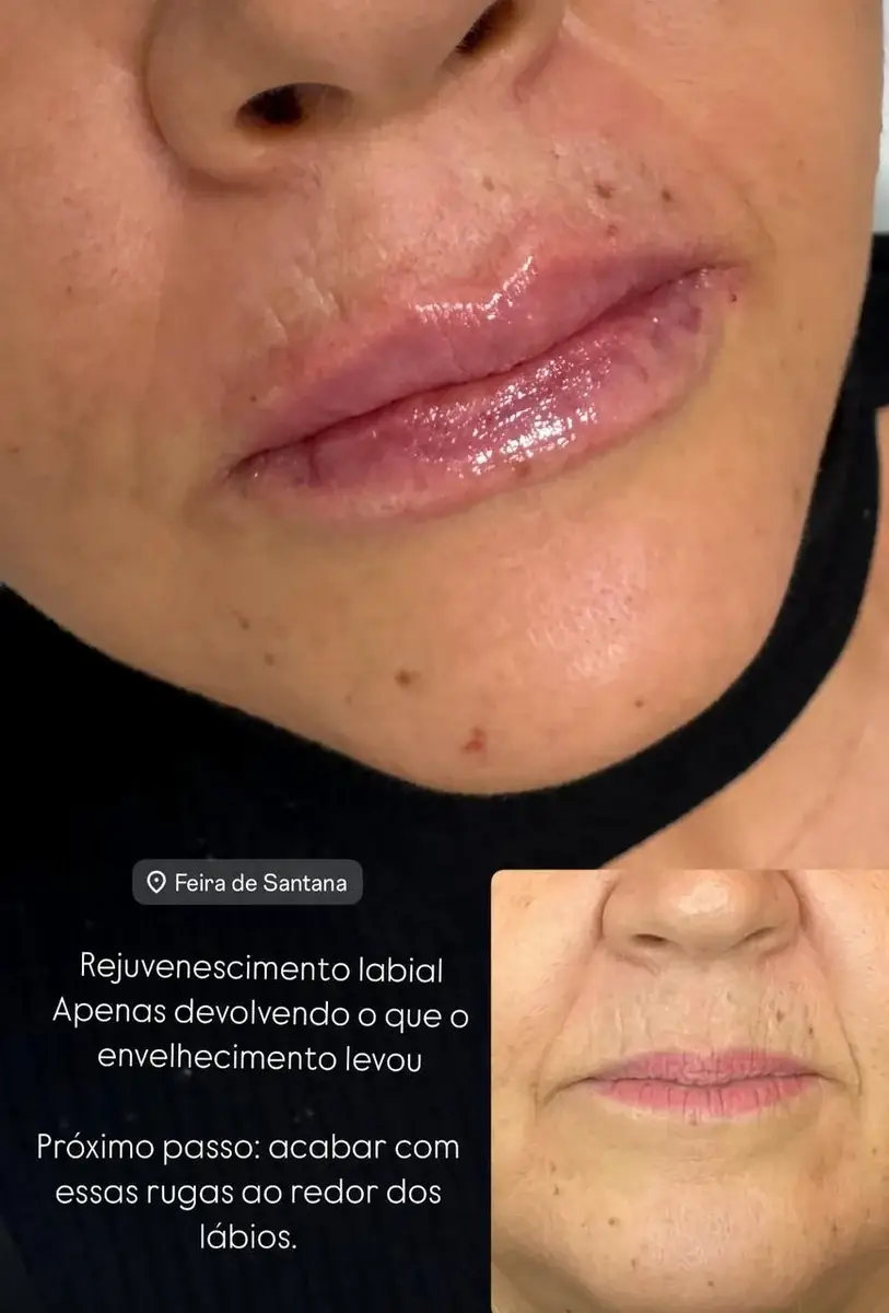 Close dos lábios femininos com aparência hidratada e rejuvenescida após procedimento estético