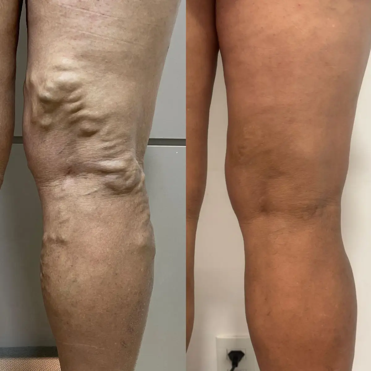 Antes e depois de tratamento de varizes na perna mostrando redução significativa das veias aparentes e melhora da textura da pele