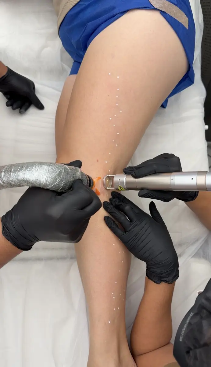 Procedimento de tratamento a laser em perna com pontos marcados e luvas pretas