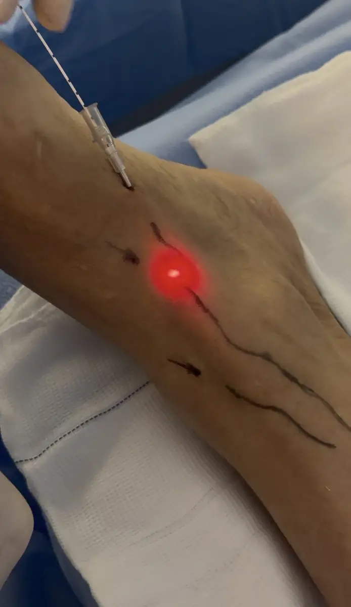 Aplicação de laser vermelho na perna com agulha para tratamento de varizes