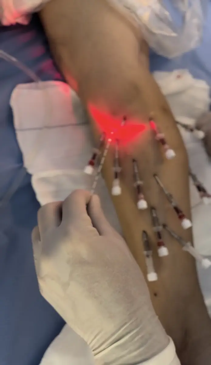 Mão com luva segurando agulhas em perna com várias inserções para tratamento de varizes com laser endovenoso técnica ATTA.